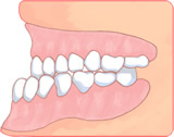 うけ口（反対咬合）