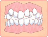 八重歯（乱杭歯、叢生）